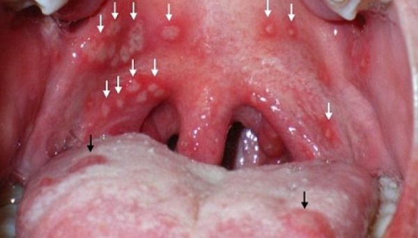 Герпесная ангина у детей: лечение, симптомы с фото горла и сыпи, подбор антибиотиков