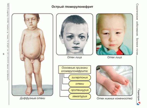 Гломерулонефрит у детей: симптомы и лечение острой и хронической формы