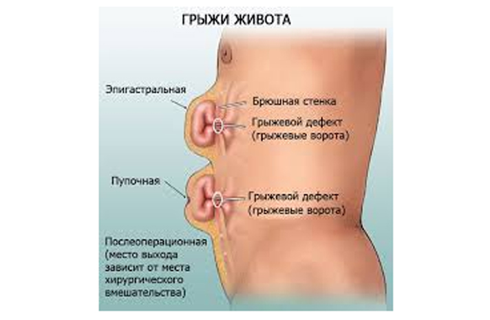 Грыжа белой линии живота у ребенка — фото, лечение надпупочной патологии и операция у новорожденных