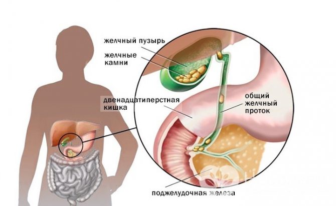 Холецистит у детей: симптомы хронической и острой форм, причины, лечение