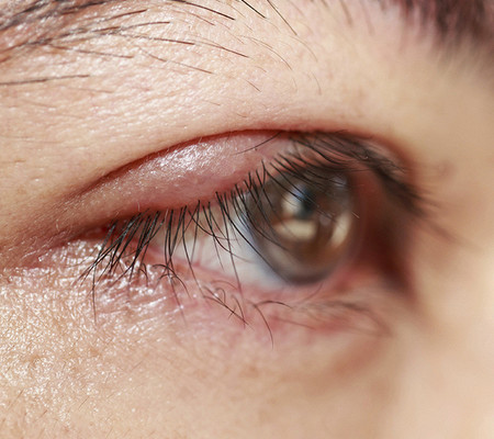 Как лечить ячмень на глазу у ребенка в домашних условиях: быстрые способы терапии чирей