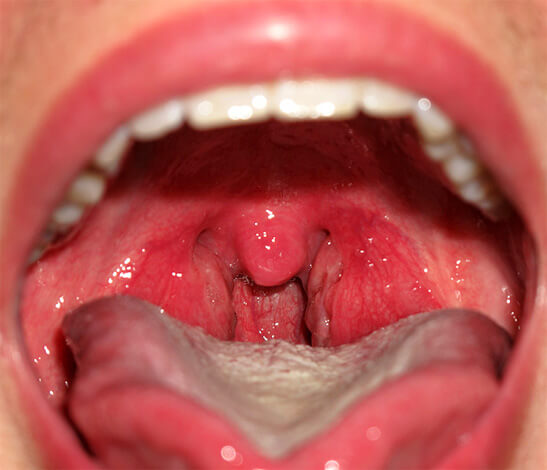 Катаральная ангина у детей: симптомы и лечение заболевания горла (фото)