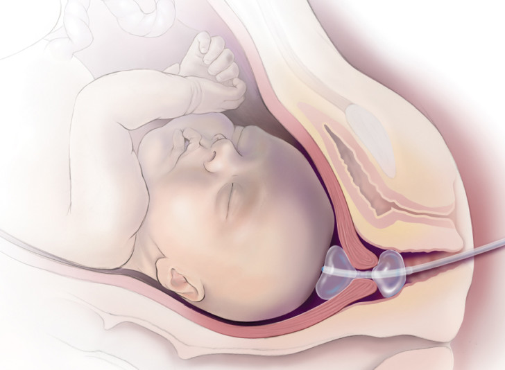 Катетер Фолея для раскрытия шейки матки перед родами: показания и порядок проведения процедуры
