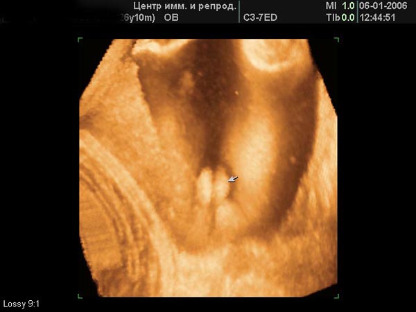 Когда формируется пол ребенка в утробе матери: на каком сроке можно его определить?