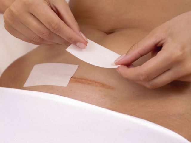 Когда после кесарева сечения можно ложиться на живот или спать на боку?