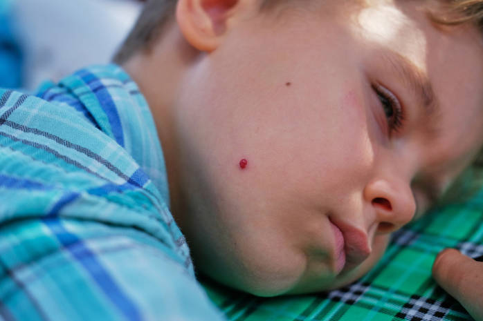 Когда у детей появляются родинки: в каком возрасте, можно ли удалять, к кому обратиться?