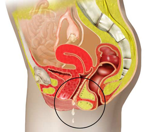 Кольпит при беременности: что это такое, какие последствия и как лечить?