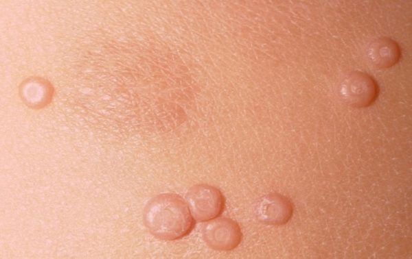 Контагиозный моллюск у детей: фото на коже, лечение и удаление на разных стадиях болезни