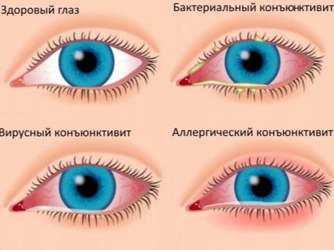 Конъюнктивит при беременности: чем лечить, какие глазные капли можно, каковы последствия для плода?