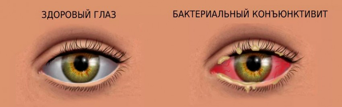 Конъюнктивит у ребенка: лечение глаз, симптомы с фото и профилактика заболевания