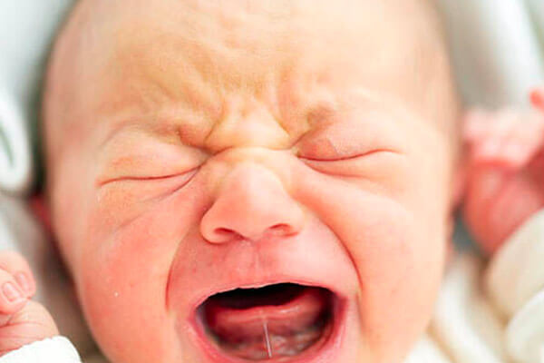 Короткая уздечка у новорожденного ребенка: в каком возрасте подрезать, как определить?