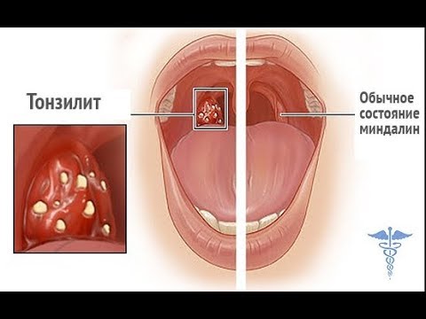 Красное горло у ребенка: чем лечить в домашних условиях и как быстро устранить боль при глотании?