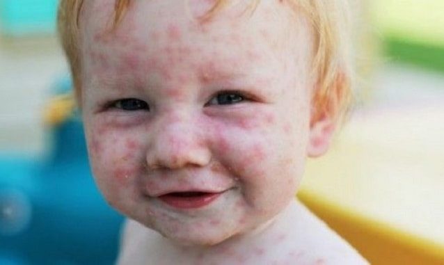 Краснуха у детей: симптомы и лечение, профилактика, фото, первые признаки сыпи