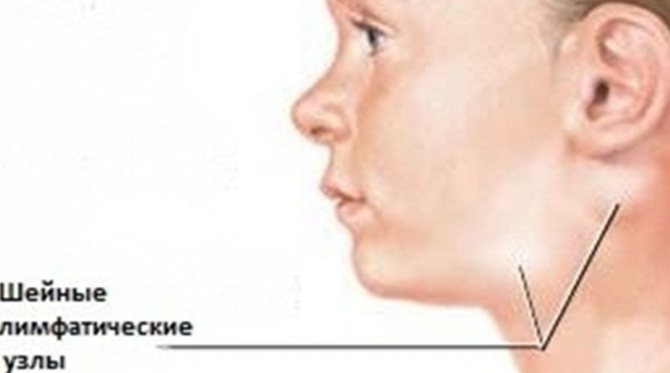 Лимфаденит у детей: симптомы, лечение и причины возникновения, профилактика