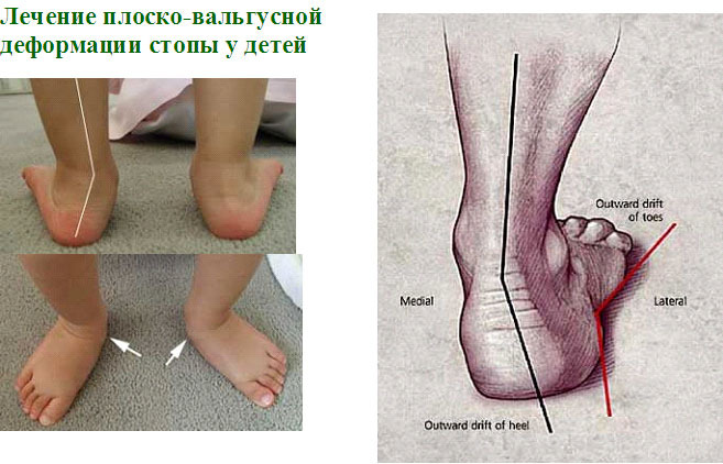 Массаж при вальгусной и плосковальгусной деформации стопы у детей: видео