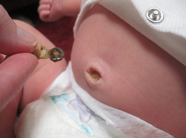 Мокнет пупок у новорожденного, не заживает, гноится: что делать?