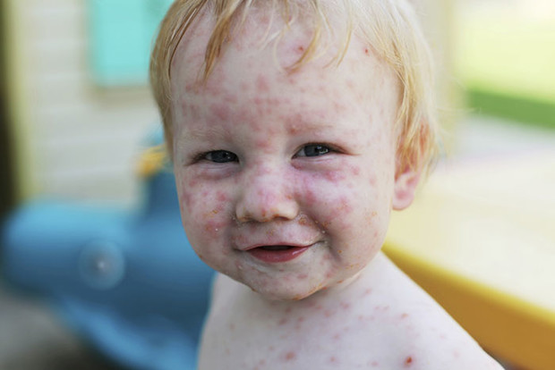 Может ли быть ветрянка без температуры у детей, как протекает болезнь, если мало высыпаний?