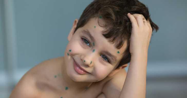 Можно ли купаться в море при ветрянке у детей, ехать на отдых после болезни и загорать на солнце?