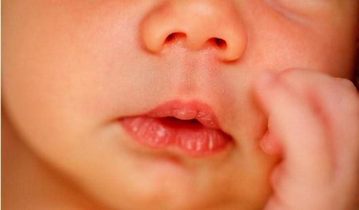 Мозоль на губе у новорожденного и грудничка: причины появления и фото с пояснениями