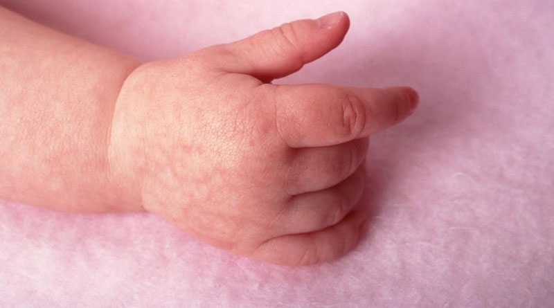 Мраморная кожа у грудничка: причины мраморности кожных покровов и лечение