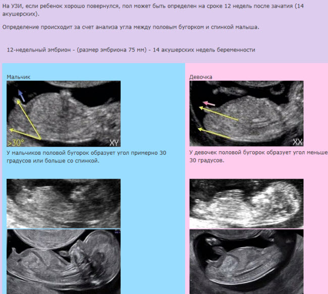 На каком сроке можно определить пол ребенка: во сколько недель точно видно на УЗИ?