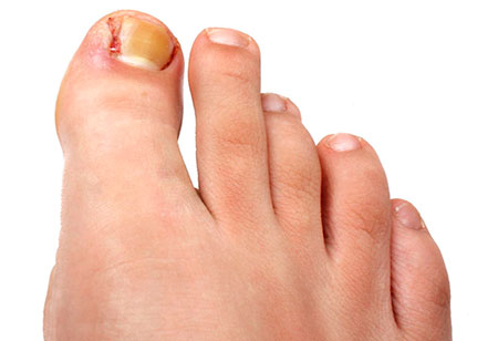Нарыв на пальце у ребенка возле ногтя: как лечить и что делать, если ранка гноится?