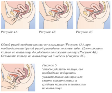 Нова Ринг — контрацептив: инструкция по применению вагинального кольца