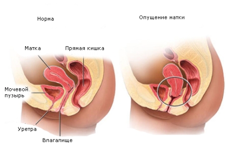 Опущение матки после родов: какие симптомы, как лечить, могут ли быть последствия?