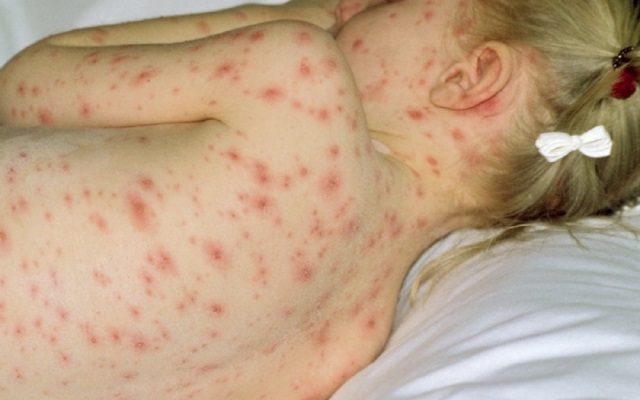 Осложнения после ветрянки у детей — какие могут быть последствия перенесенной оспы?