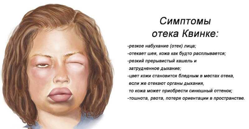 Отек Квинке: симптомы у детей, лечение, первая неотложная помощь в домашних условиях