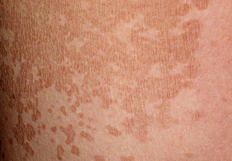 Отрубевидный лишай у ребенка (разноцветный): фото, симптомы и лечение