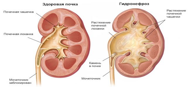 Пиелоэктазия почек у ребенка (двусторонняя, правого или левого органа) — что это такое?
