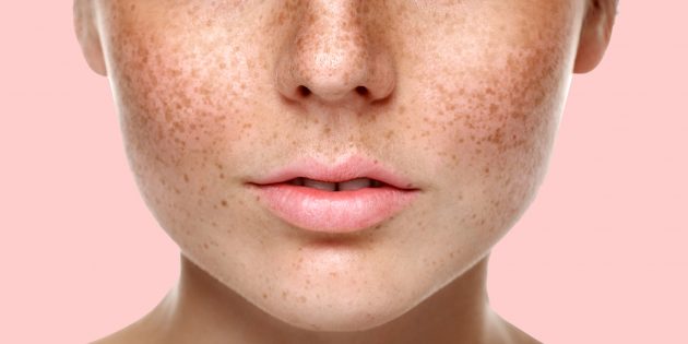 Пигментные пятна при беременности на лице, животе, груди и теле: почему возникают, как избавиться?