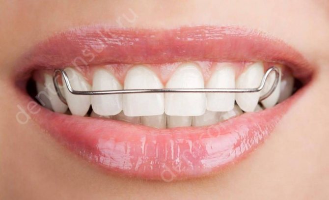 Пластинки для выравнивания зубов у детей: фото, установка, другие конструкции