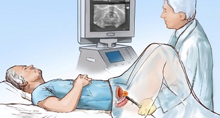 Подготовка к ТрУЗИ предстательной железы и мочевого пузыря у мужчин, техника проведения обследования