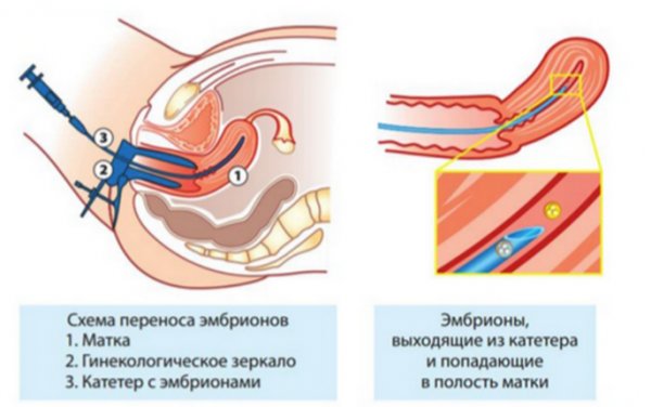 Подсадка эмбрионов по ЭКО: как происходит перенос в матку, на какой день цикла делают, каковы шансы?