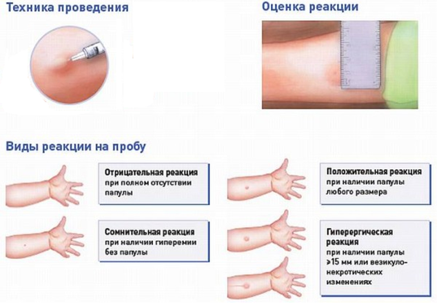 Положительная реакция Манту: что это значит и что делать родителям ребенка?