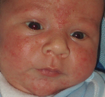 Прыщики на лице у новорожденного в 1 месяц — белые, красные (на щеках, лбу, голове)