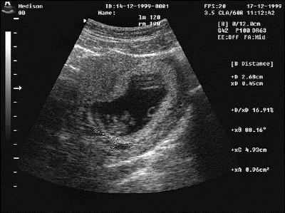 Пустое плодное яйцо или анэмбриония: причины, симптомы и методы диагностики отсутствия эмбриона