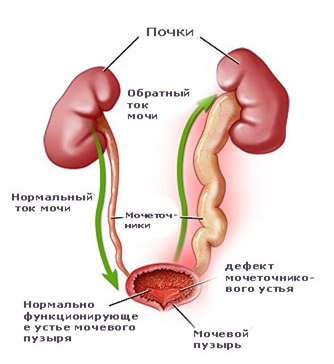 Пузырно-мочеточниковый рефлюкс у детей — симптомы и лечение двухстороннего заброса мочи в почки