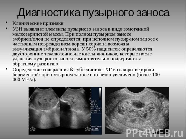 Пузырный занос при беременности — причины, симптомы частичного и полного видов: что это такое?