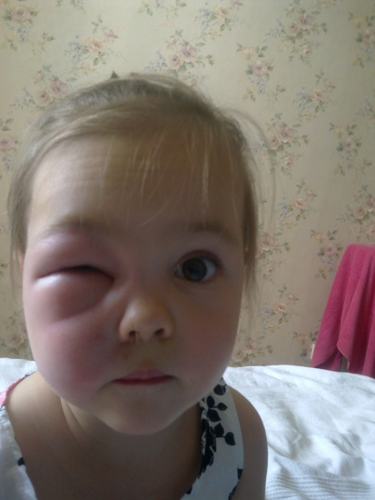 Ребенка укусил комар в глаз, все опухло — что делать, как снять отек на веке?