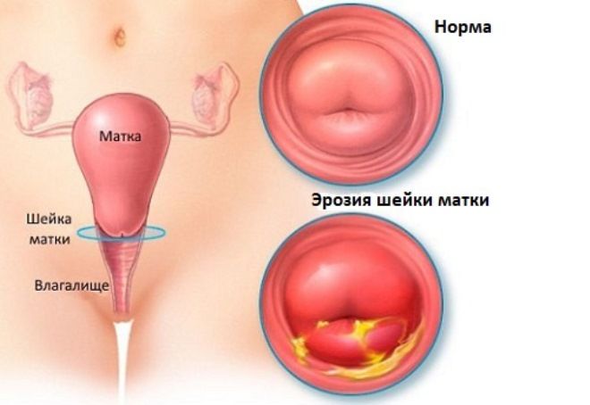 Санация влагалища и шейки матки в гинекологии: что это такое, когда проводится?