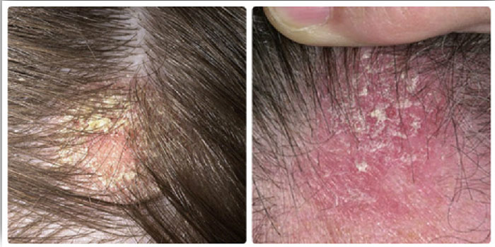 Себорейный дерматит у детей — лечение заболевания волосистой части кожи головы
