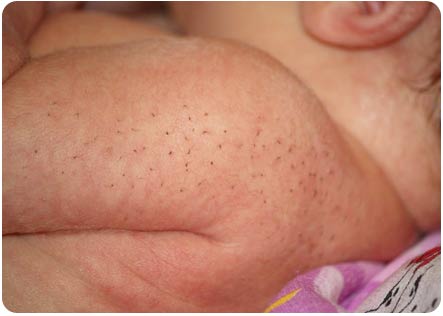 Щетина у новорожденных или кочерга: фото на ушах, спине, теле