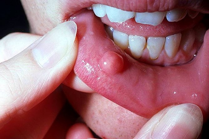 Шишка за ухом у ребенка: что это может быть и каковы причины возникновения маленьких уплотнений?