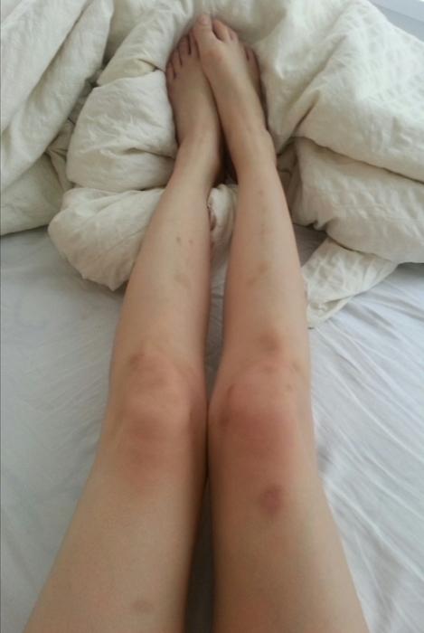 Синяки на ногах у ребенка без причины — что это и почему постоянно появляются пятна?