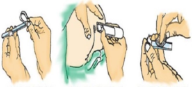 Соскоб на энтеробиоз: как берут у детей анализ, как сдавать мазок на яйца глист?