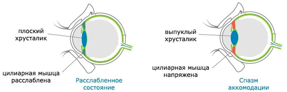 Спазм аккомодации у детей — что это такое и какое лечение необходимо для глаз?