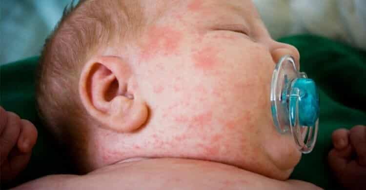 Стафилококк у детей: симптомы, лечение инфекции на коже, во рту, в кишечнике и моче